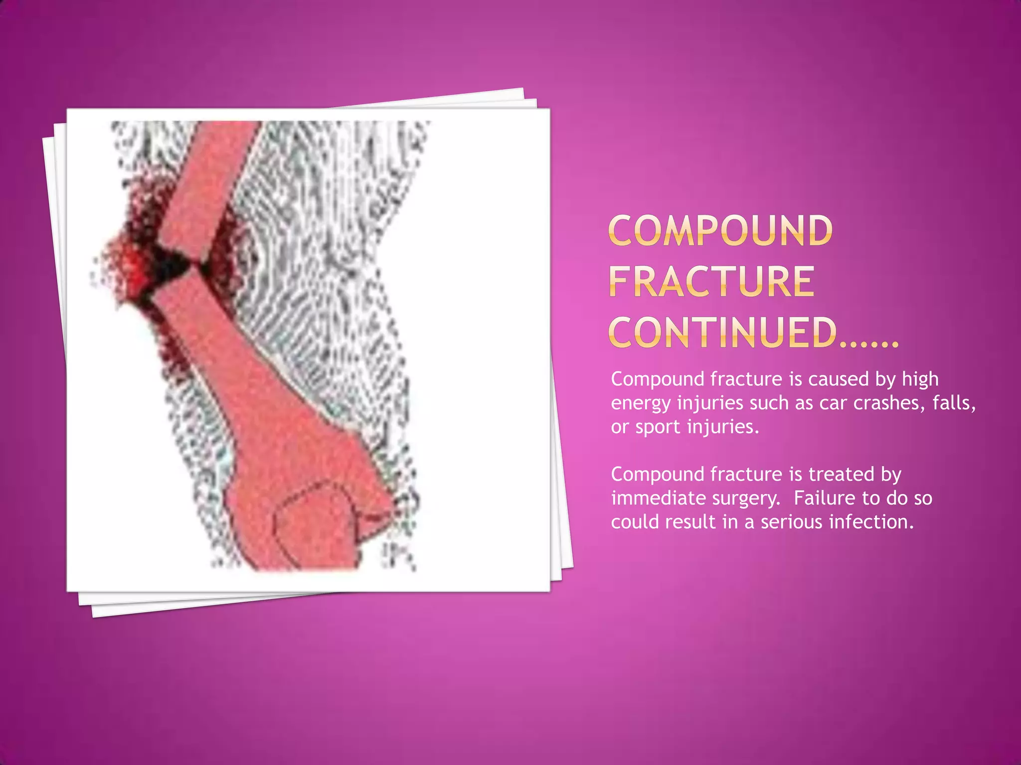 8 fractures of the bone PPTX