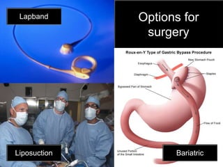 Options for surgeryLapbandLiposuctionBariatric