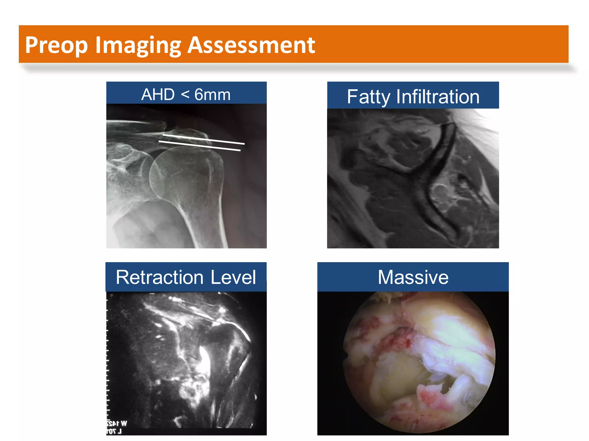 Arthroscopic management of rotator cuff tears larissa 2016 | PDF