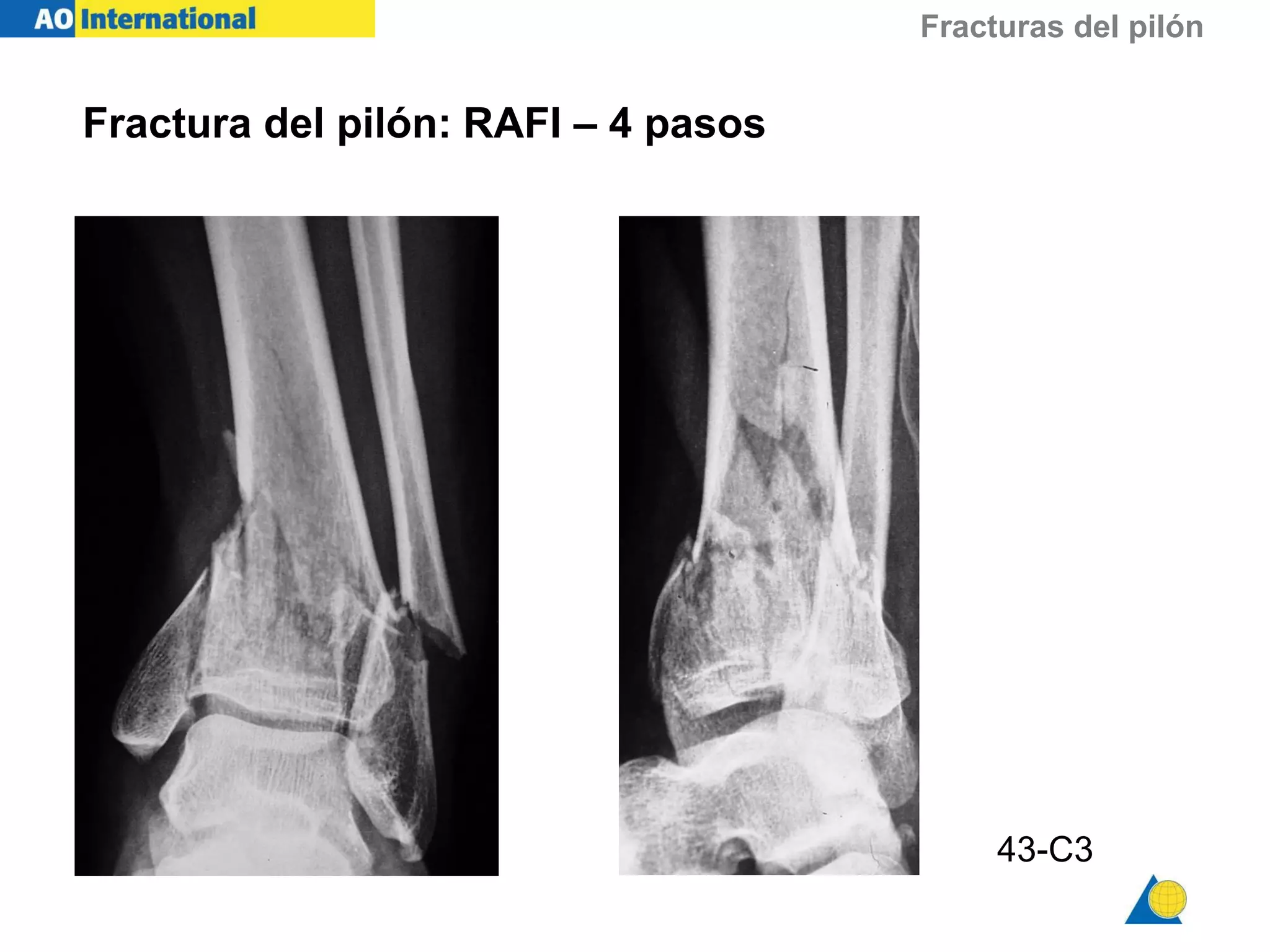 Fracturas del pilón tibial | PPT