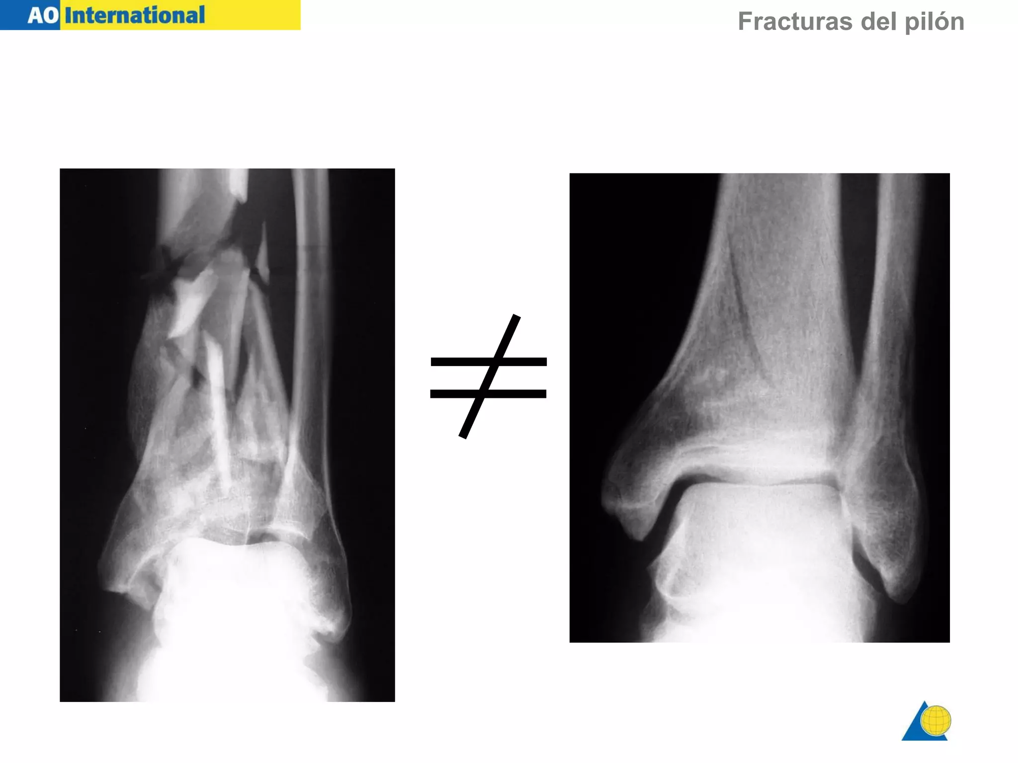 Fracturas del pilón tibial | PPT