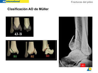 Fracturas del pilón tibial | PDF