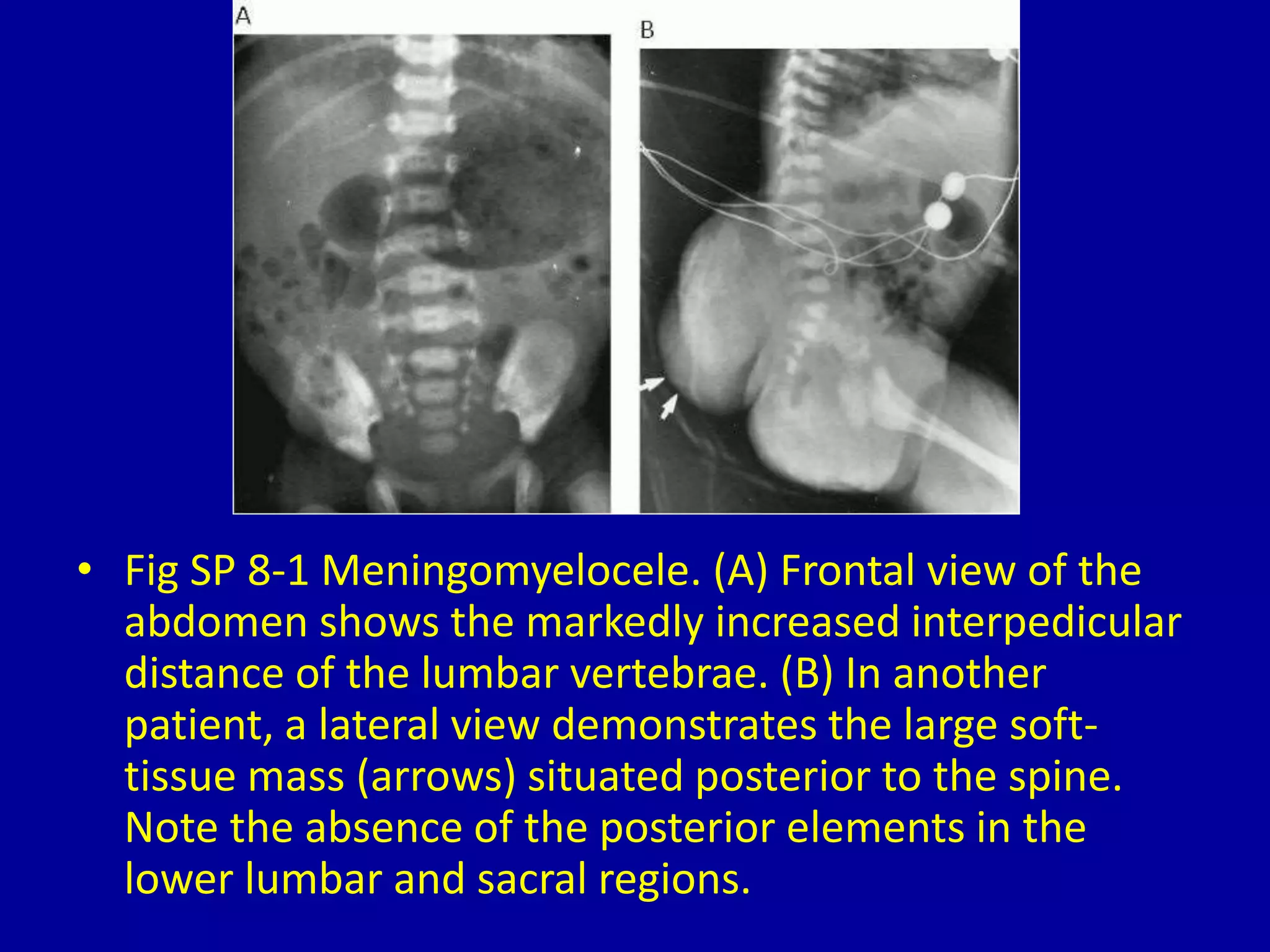 8 localized widening of the interpedicular distance | PPTX