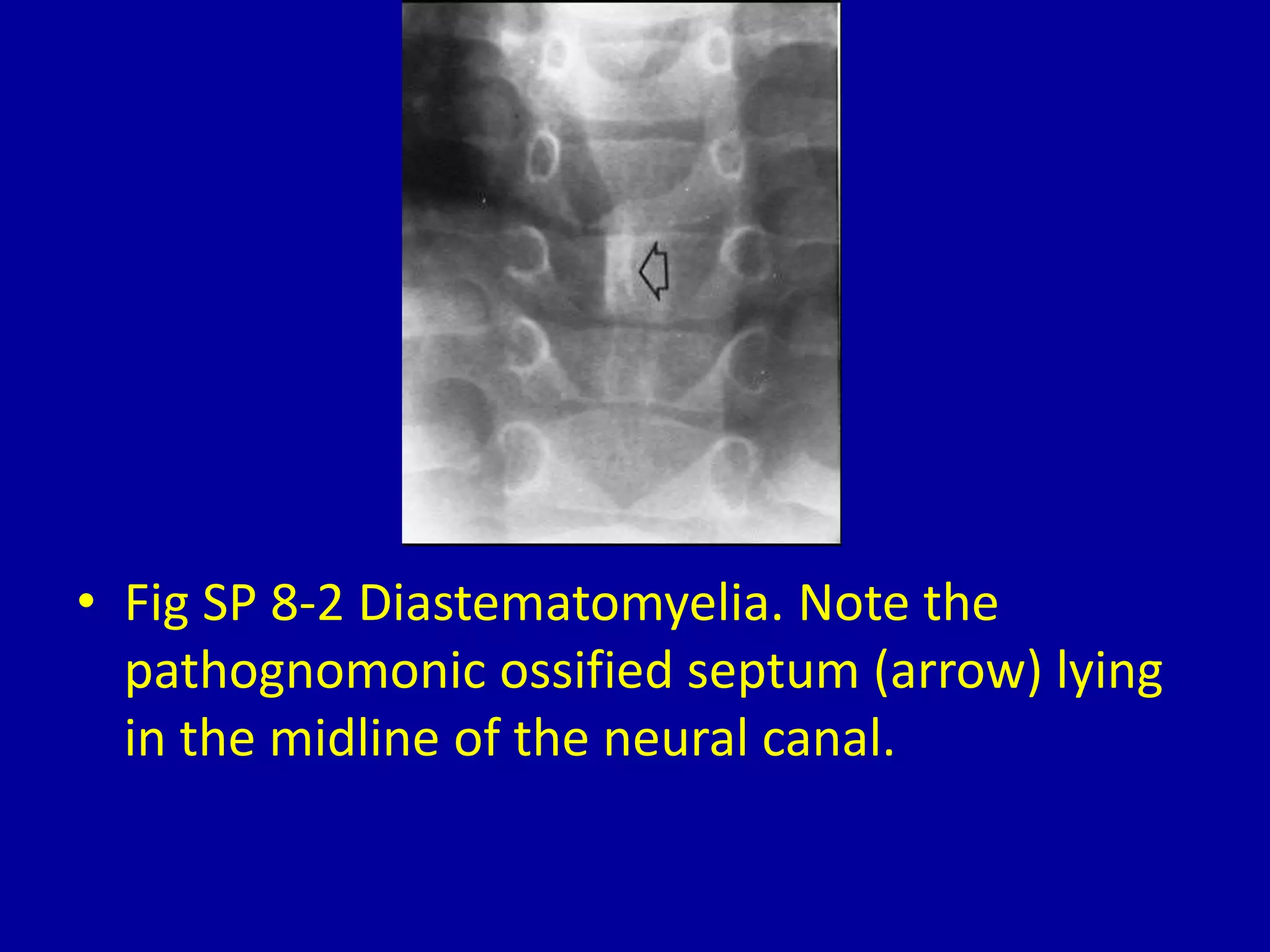 8 localized widening of the interpedicular distance | PPT