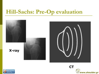 Hill-Sachs: Pre-Op evaluation
X-ray
CT
www.shoulder.gr
 
