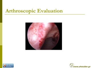 Arthroscopic Evaluation
www.shoulder.gr
 