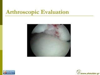 Arthroscopic Evaluation
www.shoulder.gr
 
