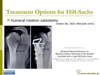 Treatment Options for Hill-Sachs
 Humeral rotation osteotomy
(Weber BG, JBJS 1984;66A:1443)
www.shoulder.gr
 