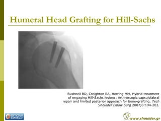 Humeral Head Grafting for Hill-Sachs
Bushnell BD, Creighton RA, Herring MM. Hybrid treatment
of engaging Hill-Sachs lesions: Arthroscopic capsulolabral
repair and limited posterior approach for bone-grafting. Tech
Shoulder Elbow Surg 2007;8:194-203.
www.shoulder.gr
 