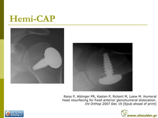 Hemi-CAP
Raiss P, Aldinger PR, Kasten P, Rickert M, Loew M. Humeral
head resurfacing for fixed anterior glenohumeral dislocation.
Int Orthop 2007 Dec 19 [Epub ahead of print]
www.shoulder.gr
 