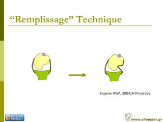 “Remplissage” Technique
Eugene Wolf, 2004,Arthroscopy
www.shoulder.gr
 