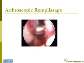 Arthroscopic Remplissage
www.shoulder.gr
 