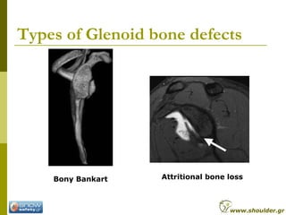 Types of Glenoid bone defects
Bony Bankart Attritional bone loss
www.shoulder.gr
 