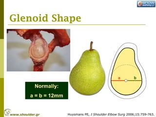 Glenoid Shape
a b
Normally:
a = b = 12mm
Huysmans PE, J Shoulder Elbow Surg 2006;15:759-763.www.shoulder.gr
 