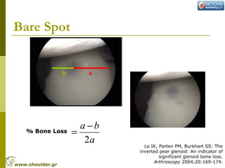 Bare Spot
b a
% Bone Loss
Lo IK, Parten PM, Burkhart SS: The
inverted pear glenoid: An indicator of
significant glenoid bone loss.
Arthroscopy 2004;20:169-174.
a
ba
2
−
=
www.shoulder.gr
 