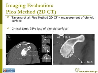 Imaging Evaluation:
Pico Method (2D CT)
 Taverna et al. Pico Method 2D CT – measurement of glenoid
surface
 Critical Limit 25% loss of glenoid surface
www.shoulder.gr
 