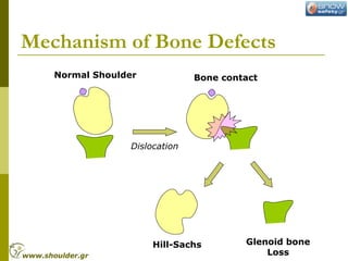 Mechanism of Bone Defects
Hill-Sachs Glenoid bone
Loss
Normal Shoulder Bone contact
Dislocation
www.shoulder.gr
 