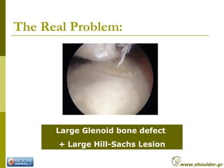 The Real Problem:
Large Glenoid bone defect
+ Large Hill-Sachs Lesion
www.shoulder.gr
 