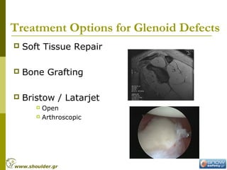 Treatment Options for Glenoid Defects
 Soft Tissue Repair
 Bone Grafting
 Bristow / Latarjet
 Open
 Arthroscopic
www.shoulder.gr
 