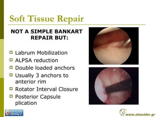 Soft Tissue Repair
NOT A SIMPLE BANKART
REPAIR BUT:
 Labrum Mobilization
 ALPSA reduction
 Double loaded anchors
 Usually 3 anchors to
anterior rim
 Rotator Interval Closure
 Posterior Capsule
plication
www.shoulder.gr
 