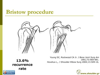 Bristow procedure
Young DC, Rockwood CA Jr. J Bone Joint Surg Am
1991;73:969-981.
Hovelius L,. J Shoulder Elbow Surg 2004;13:509-16.13.6%
recurrence
rate
www.shoulder.gr
 
