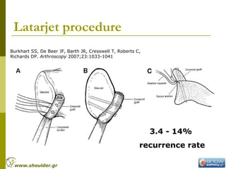 Latarjet procedure
Burkhart SS, De Beer JF, Barth JR, Cresswell T, Roberts C,
Richards DP. Arthroscopy 2007;23:1033-1041
3.4 - 14%
recurrence rate
www.shoulder.gr
 
