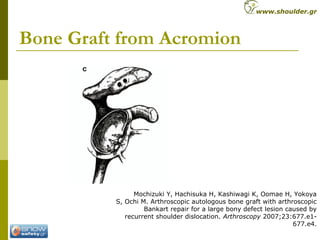Bone Graft from Acromion
Mochizuki Y, Hachisuka H, Kashiwagi K, Oomae H, Yokoya
S, Ochi M. Arthroscopic autologous bone graft with arthroscopic
Bankart repair for a large bony defect lesion caused by
recurrent shoulder dislocation. Arthroscopy 2007;23:677.e1-
677.e4.
www.shoulder.gr
 