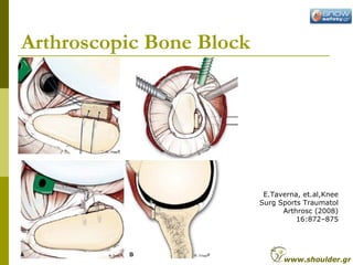Arthroscopic Bone Block
E.Taverna, et.al,Knee
Surg Sports Traumatol
Arthrosc (2008)
16:872–875
www.shoulder.gr
 