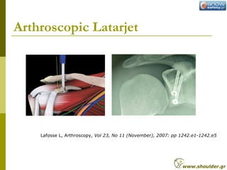 Arthroscopic Latarjet
Lafosse L, Arthroscopy, Vol 23, No 11 (November), 2007: pp 1242.e1-1242.e5
www.shoulder.gr
 