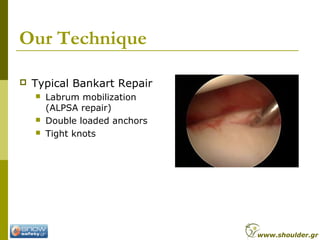 Our Technique
 Typical Bankart Repair
 Labrum mobilization
(ALPSA repair)
 Double loaded anchors
 Tight knots
www.shoulder.gr
 