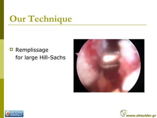 Our Technique
 Remplissage
for large Hill-Sachs
www.shoulder.gr
 