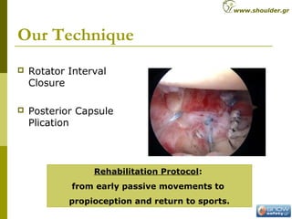 Our Technique
 Rotator Interval
Closure
 Posterior Capsule
Plication
Rehabilitation Protocol:
from early passive movements to
propioception and return to sports.
www.shoulder.gr
 