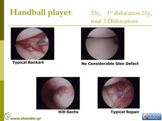 Handball player: 23y, 1st
dislocation 21y,
total 3 Dislocations
Typical Bankart No Considerable Glen Defect
Hill-Sachs Typical Repair
www.shoulder.gr
 