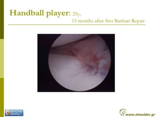 Handball player: 25y,
15 months after first Bankart Repair
www.shoulder.gr
 