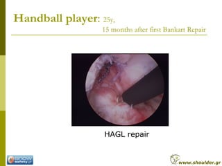 HAGL repair
Handball player: 25y,
15 months after first Bankart Repair
www.shoulder.gr
 