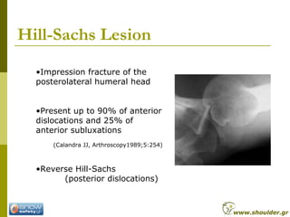 Hill-Sachs Lesion
•Impression fracture of the
posterolateral humeral head
•Present up to 90% of anterior
dislocations and 25% of
anterior subluxations
(Calandra JJ, Arthroscopy1989;5:254)
•Reverse Hill-Sachs
(posterior dislocations)
www.shoulder.gr
 