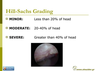 Hill-Sachs Grading
 MINOR: Less than 20% of head
 MODERATE: 20-40% of head
 SEVERE: Greater than 40% of head
www.shoulder.gr
 