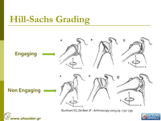 Hill-Sachs Grading
Engaging
Non Engaging
Burkhart SS, De Beer JF : Arthroscopy 2003;19 : 732–739
www.shoulder.gr
 