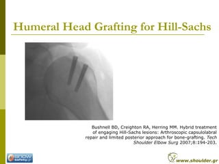 Humeral Head Grafting for Hill-Sachs
Bushnell BD, Creighton RA, Herring MM. Hybrid treatment
of engaging Hill-Sachs lesion...
