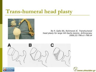 Trans-humeral head plasty
Re P, Gallo RA, Richmond JC. Transhumeral
head plasty for large Hill-Sachs lesions. Arthroscopy
...