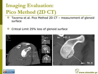 Imaging Evaluation:
Pico Method (2D CT)
 Taverna et al. Pico Method 2D CT – measurement of glenoid
surface
 Critical Lim...