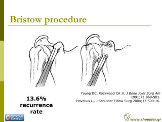 Bristow procedure
Young DC, Rockwood CA Jr. J Bone Joint Surg Am
1991;73:969-981.
Hovelius L,. J Shoulder Elbow Surg 2004;...
