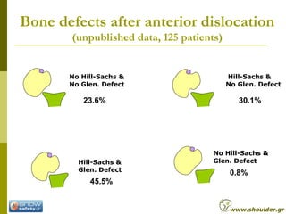 Bone defects after anterior dislocation
(unpublished data, 125 patients)
Hill-Sachs &
Glen. Defect
Hill-Sachs &
No Glen. D...
