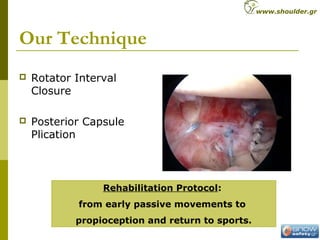 Our Technique
 Rotator Interval
Closure
 Posterior Capsule
Plication
Rehabilitation Protocol:
from early passive movemen...