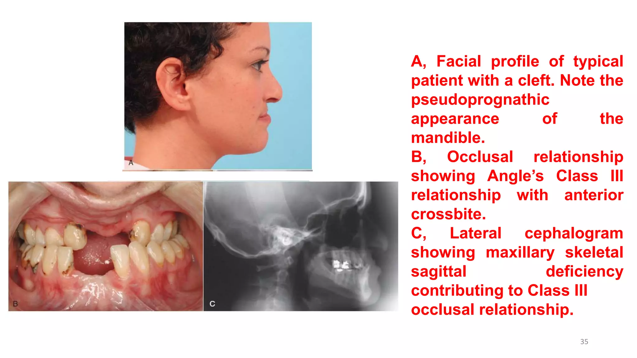 A, Facial profile of typical
patient with a cleft. Note the
pseudoprognathic
appearance of the
mandible.
B, Occlusal relationship
showing Angle’s Class III
relationship with anterior
crossbite.
C, Lateral cephalogram
showing maxillary skeletal
sagittal deficiency
contributing to Class III
occlusal relationship.
35
 