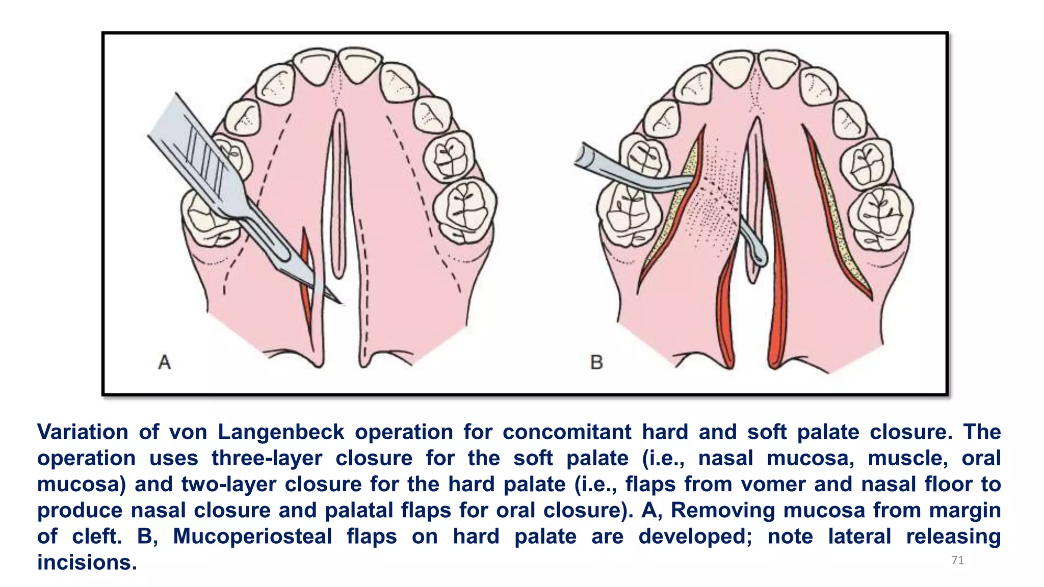 Variation of von Langenbeck operation for concomitant hard and soft palate closure. The
operation uses three-layer closure for the soft palate (i.e., nasal mucosa, muscle, oral
mucosa) and two-layer closure for the hard palate (i.e., flaps from vomer and nasal floor to
produce nasal closure and palatal flaps for oral closure). A, Removing mucosa from margin
of cleft. B, Mucoperiosteal flaps on hard palate are developed; note lateral releasing
incisions. 71
 