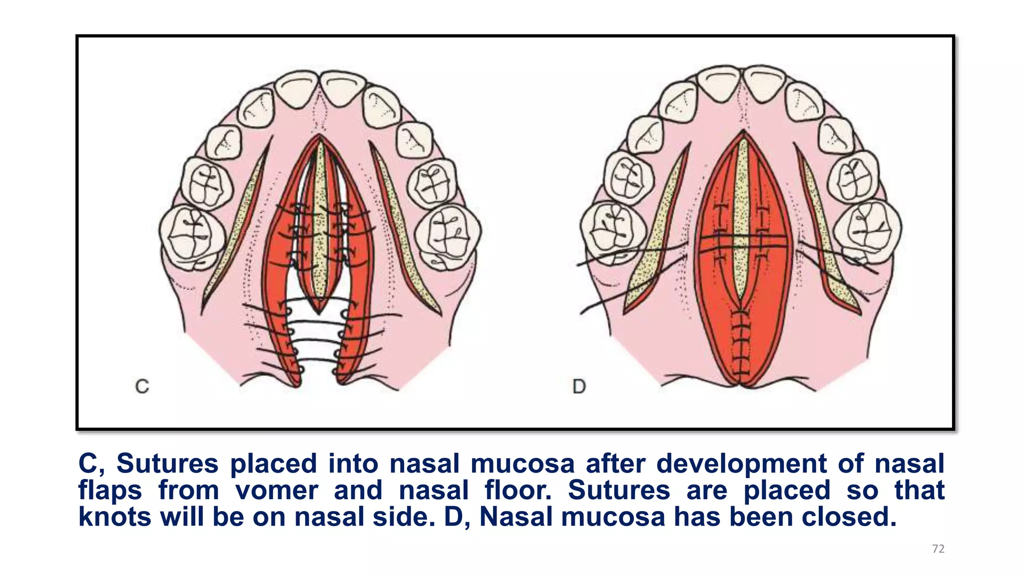 C, Sutures placed into nasal mucosa after development of nasal
flaps from vomer and nasal floor. Sutures are placed so that
knots will be on nasal side. D, Nasal mucosa has been closed.
72
 