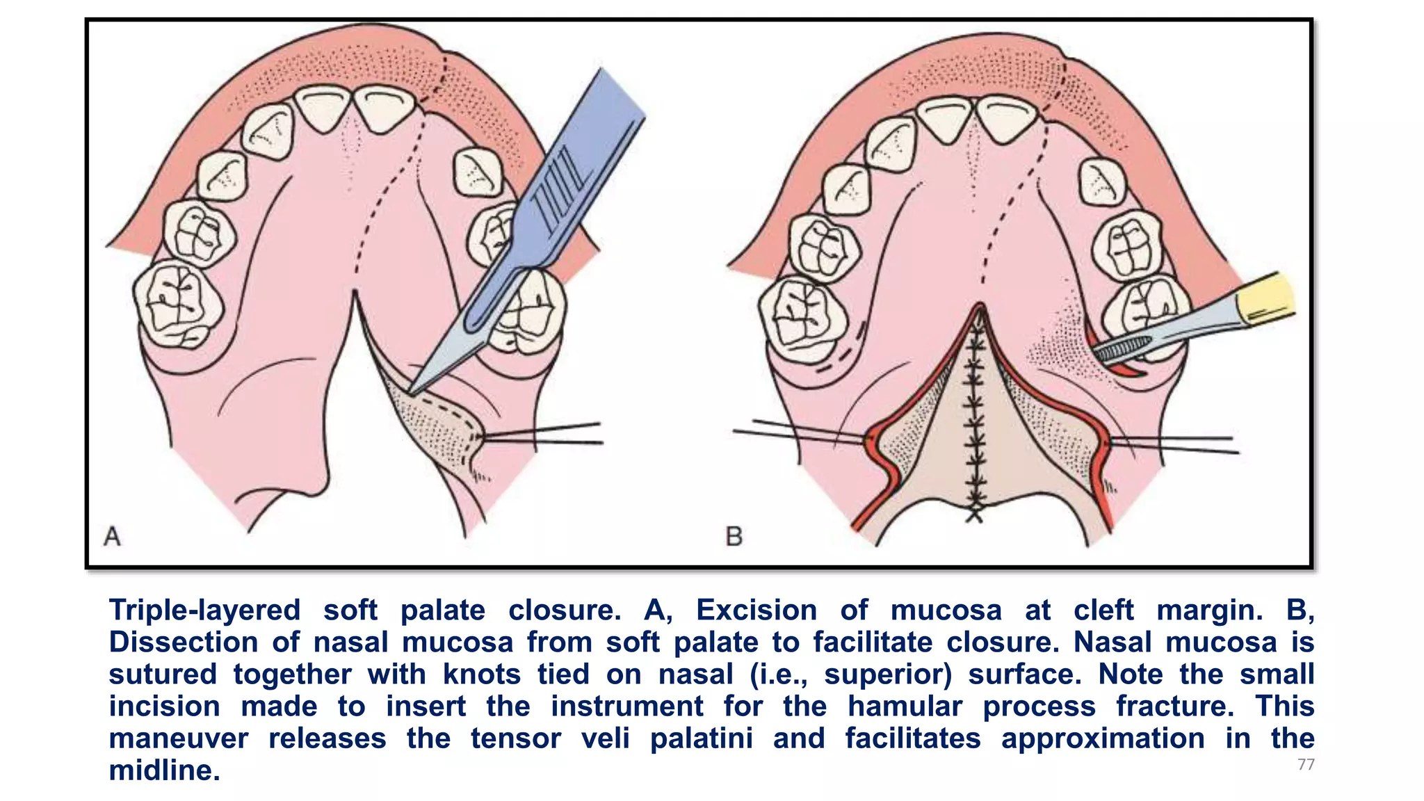 Triple-layered soft palate closure. A, Excision of mucosa at cleft margin. B,
Dissection of nasal mucosa from soft palate to facilitate closure. Nasal mucosa is
sutured together with knots tied on nasal (i.e., superior) surface. Note the small
incision made to insert the instrument for the hamular process fracture. This
maneuver releases the tensor veli palatini and facilitates approximation in the
midline. 77
 