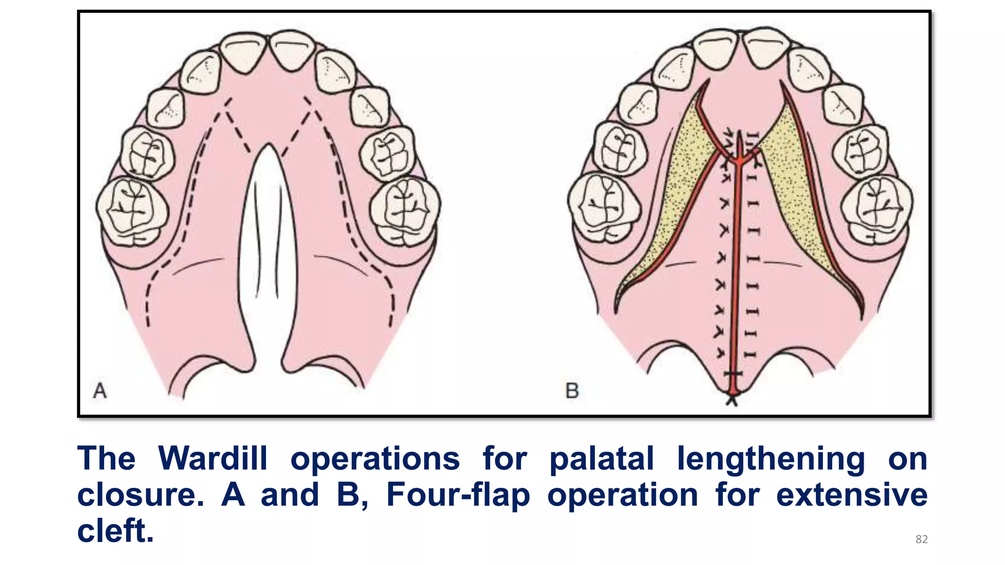 The Wardill operations for palatal lengthening on
closure. A and B, Four-flap operation for extensive
cleft. 82
 