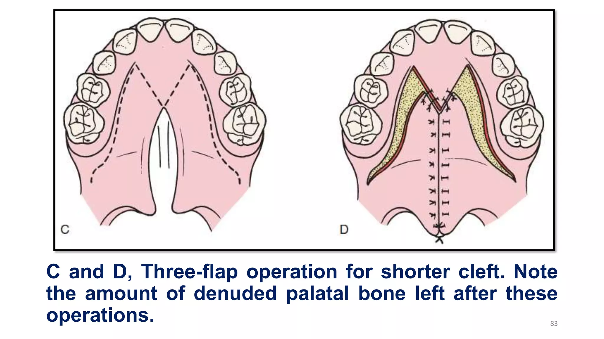 C and D, Three-flap operation for shorter cleft. Note
the amount of denuded palatal bone left after these
operations. 83
 